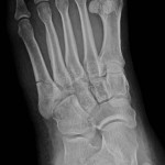 Lisa's Broken Foot X-Rays
