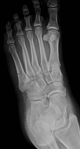 fractured foot bone